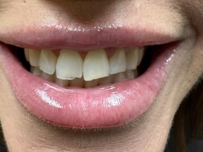 Smile Gallery - Composite Repair 1 Before