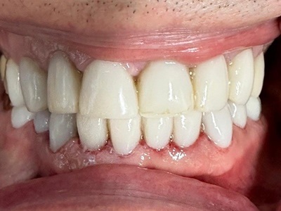 Smile Gallery - Composite Veneer 1 After