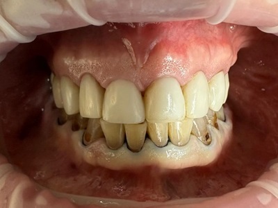 Smile Gallery - Composite Veneer 1 Before