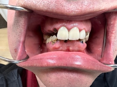 Smile Gallery - Full Mouth Reconstruction 1 Before